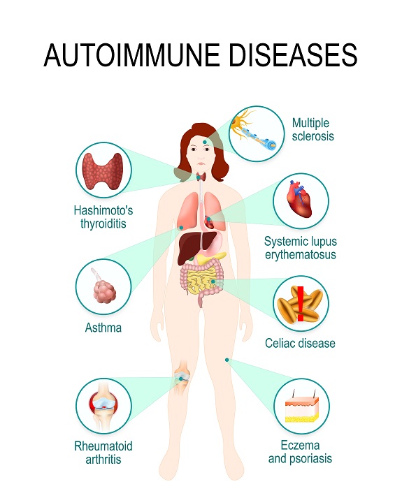 autoimmune diseases autoimmune diseases